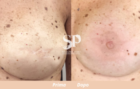 dermopigmentazione dell'areola mammaria (prima e dopo)