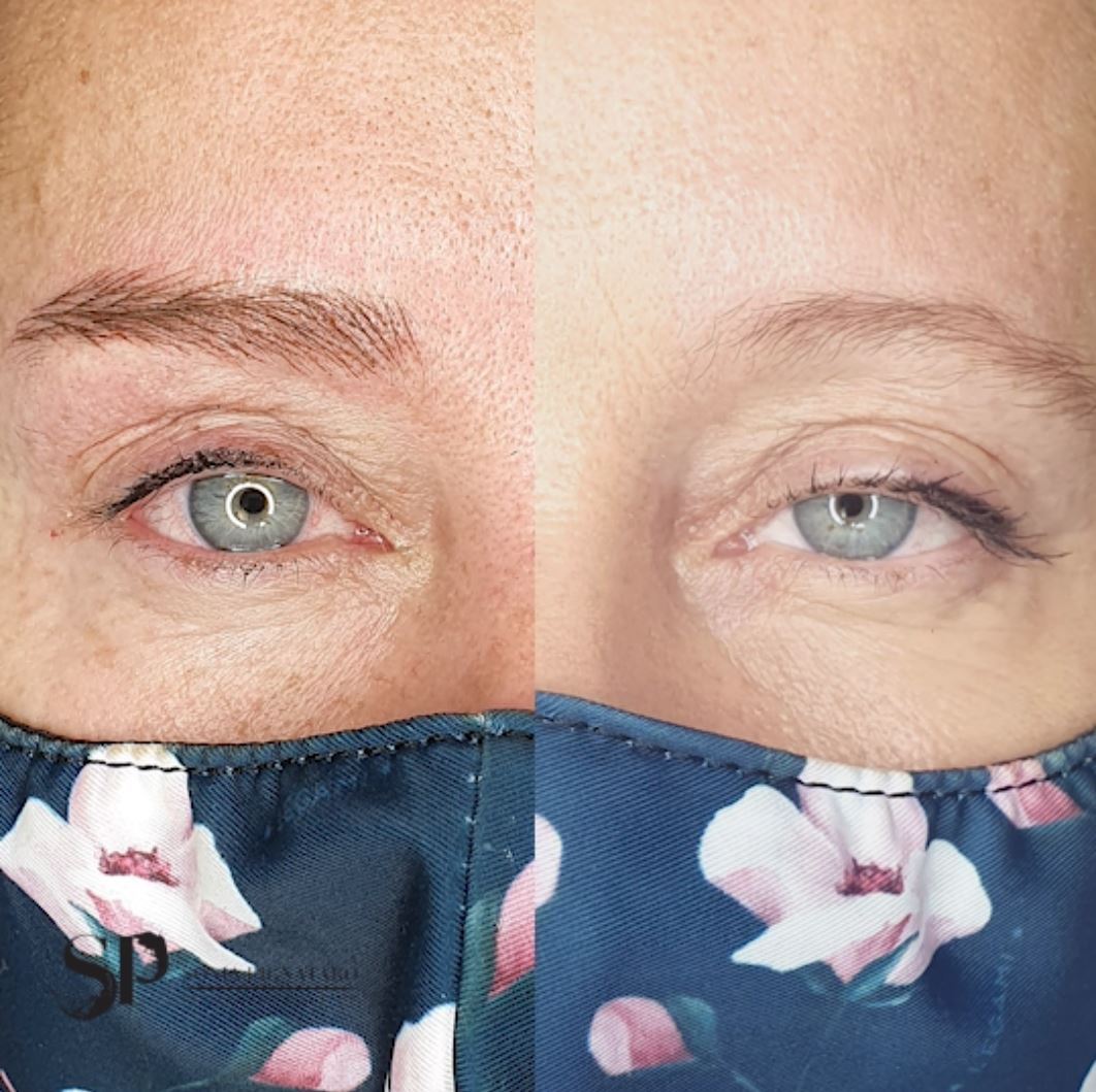 Sopracciglia iperrealistiche realizzate su una pelle molto sensibile, grassa e vascolarizzata