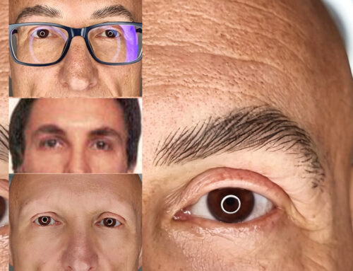 Alopecia maschile