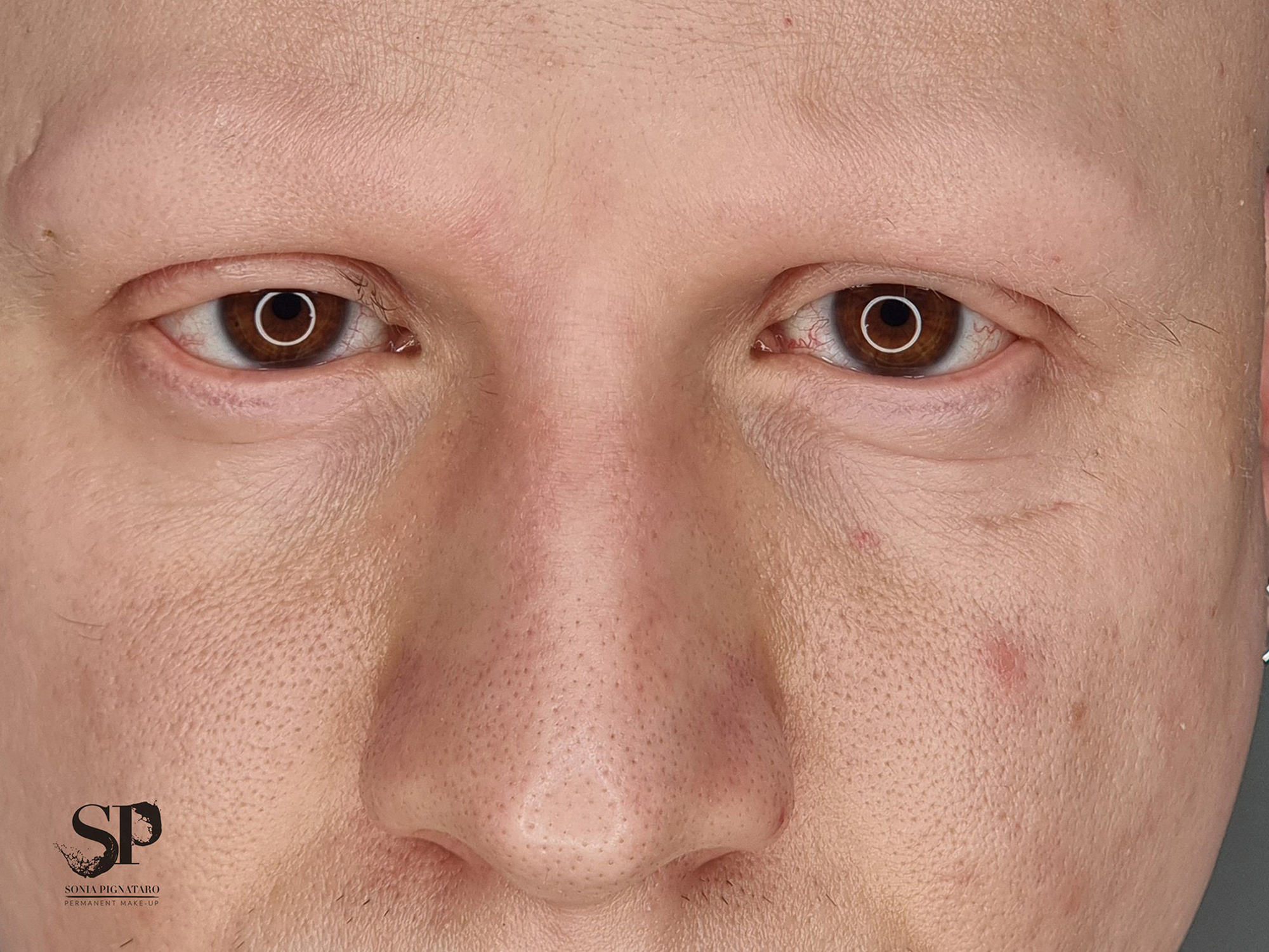 Alopecia sopracciglia prima del trattamento