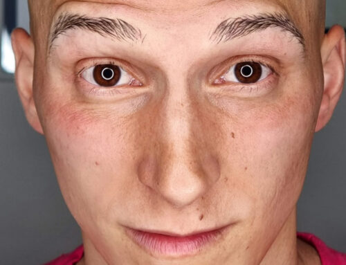 Sopracciglio maschile tatuato su alopecia totale