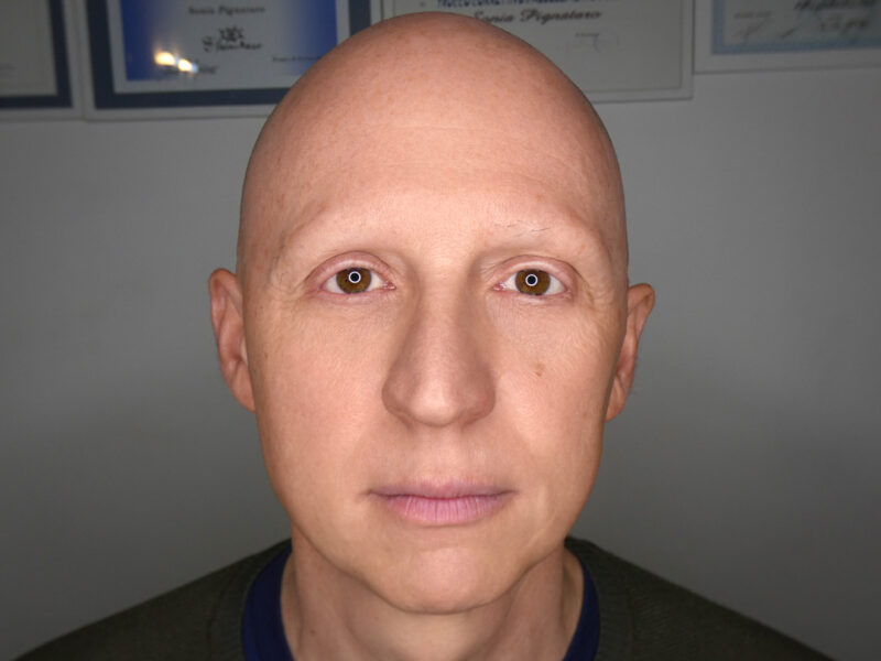 Alopecia areata su sopracciglia maschili con perdita parziale