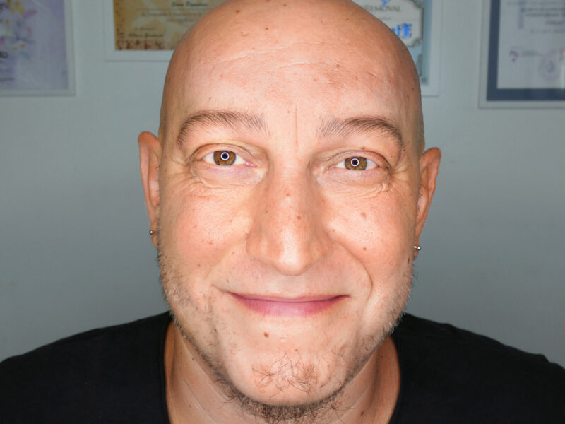 Ricostruzione sopracciglia uomo con alopecia totale tramite Velvet Brows