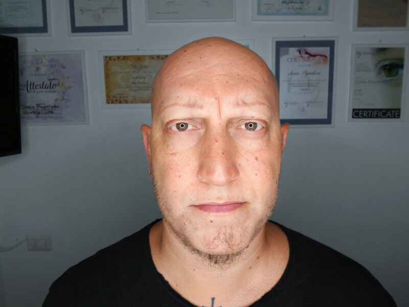 Alopecia totale sopracciglia su uomo giovane prima del trattamento