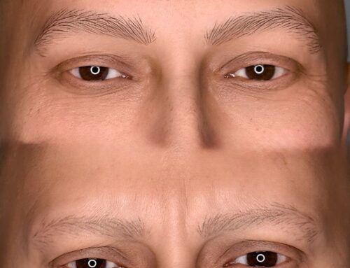 Alopecia maschile delle sopraccialia, guarigione vista dopo 18 mesi