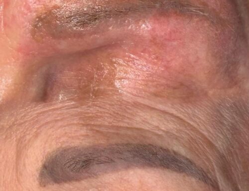 Un tatuaggio che non ti rappresenta più? Dopo solo 1 sessione, i risultati parlano da soli. La tua pelle ringrazia