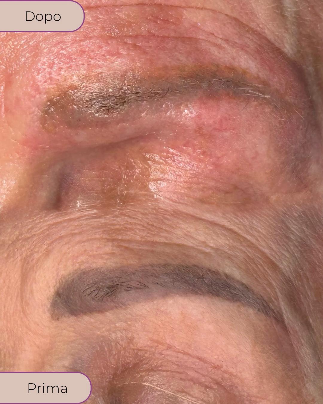 Vecchio tatuaggio sbiadito e poco estetico prima del trattamento di copertura con dermopigmentazione.