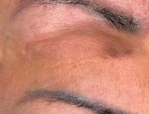 Rimozione di un vecchio tatuaggio alle sopracciglia: libera la tua pelle dal passato: ora è più chiara e pronta per il futuro