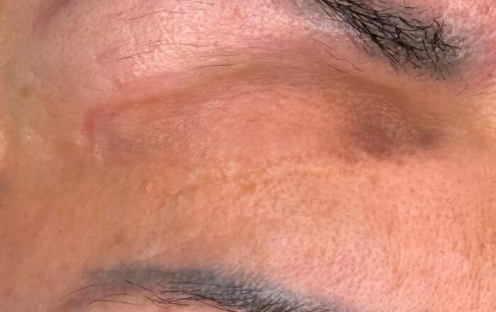 Risultato dopo il trattamento di correzione del tatuaggio con pelle più chiara e uniforme.