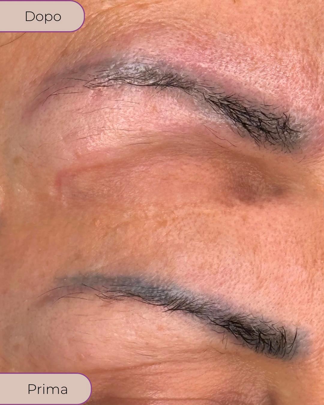 Risultato dopo il trattamento di correzione del tatuaggio con pelle più chiara e uniforme.