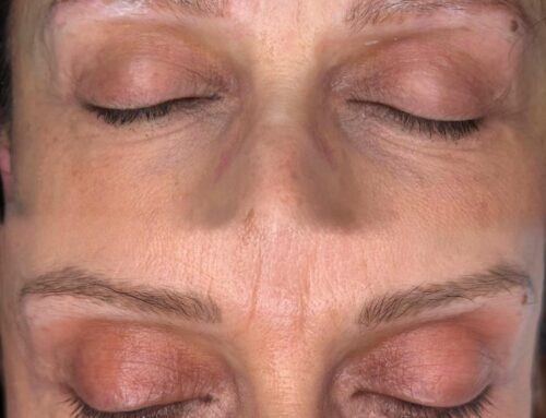 Sopracciglio femminile prima & dopo 1 trattamento: rimozione colore graduale, con lieve rossore normale