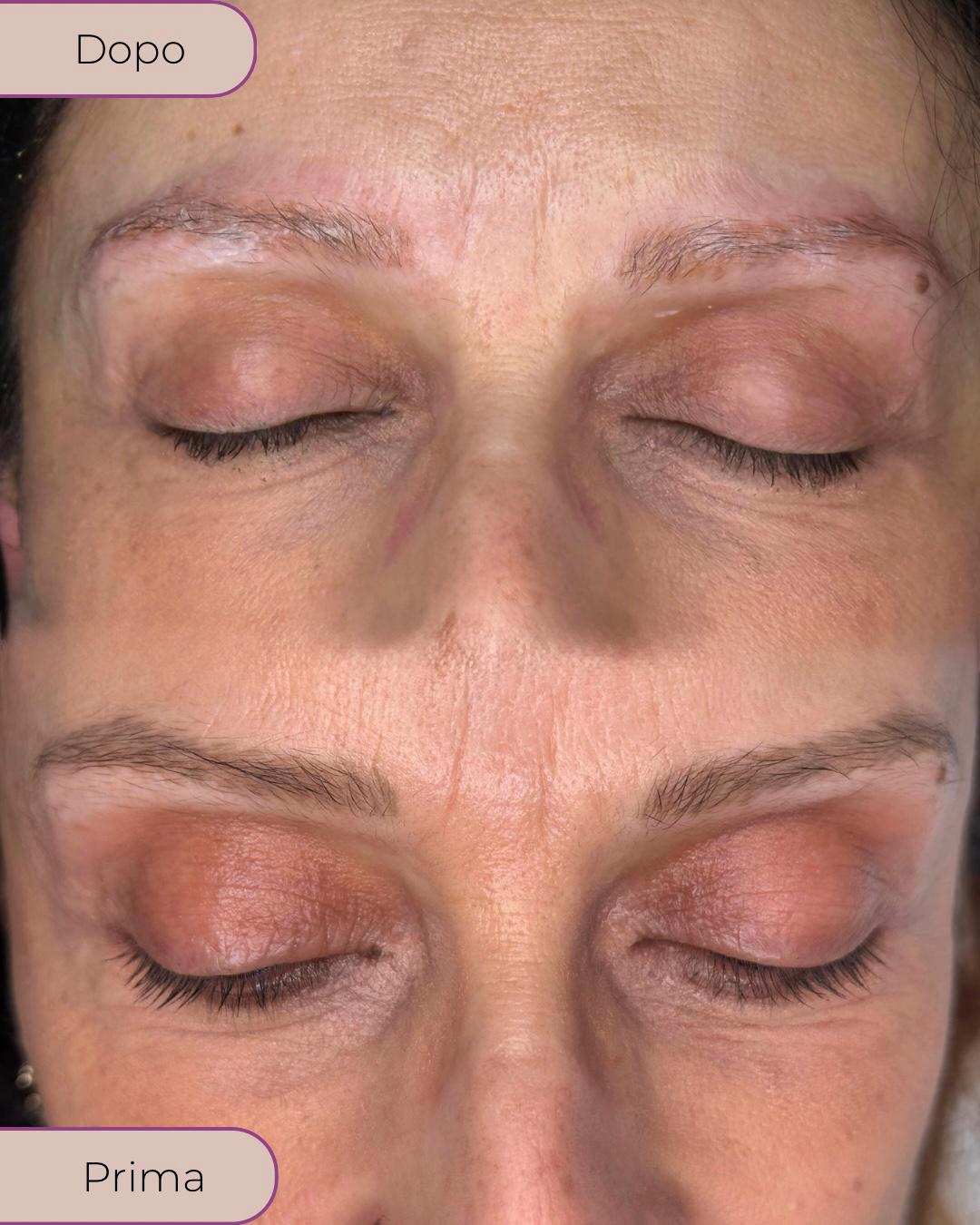 Risultato dopo il primo trattamento PMU di rimozione del pigmento: il colore risulta già più attenuato e la pelle presenta un lieve rossore temporaneo, normale dopo la seduta.