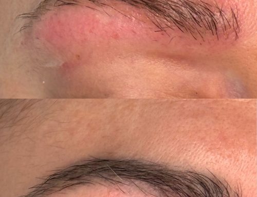 Trattamento di rimozione colore alle sopracciglia (prima e dopo)
