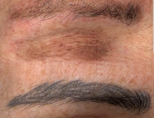 Correzione e Rimozione del Trucco Permanente: Perché Ogni Pelle Richiede un Approccio su Misura