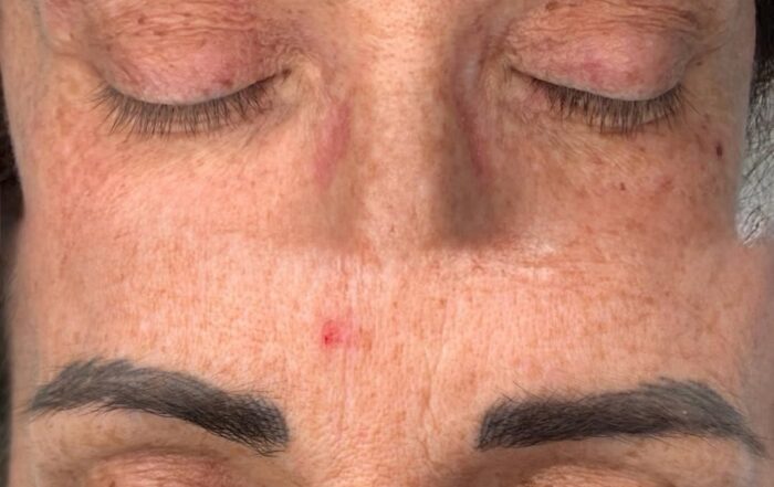 Prima e dopo la pulizia del colore di un vecchio trucco permanente alle sopracciglia, passaggio preparatorio eseguito a Roma da Sonia Pignataro.